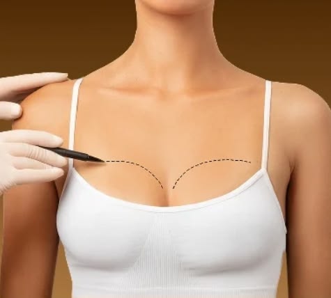 Breast Lift